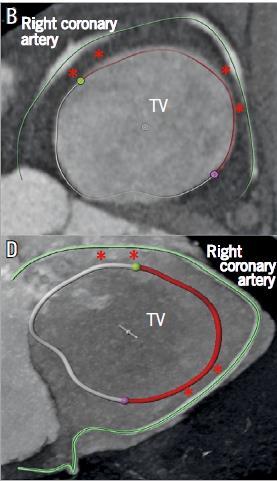 Mitral and Tricuspid Annulus: Relation with coronary arteries Tricuspid annulus in