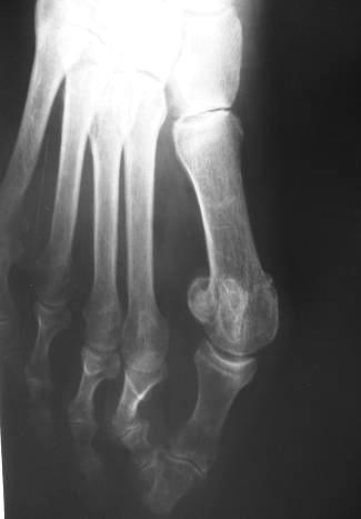 prve metatarzalne, kosti u kombinaciji s Weilovom osteotomijom druge i treće metatarzalne kosti, te resekcijom distalnoga kraja proksimalne falange drugoga prsta. Prijeoperativni klinički izgled (A).