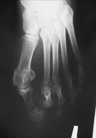 Picture 1 A severe case of hallux valgus in association with overriding second toe and claw third toe and with an excess of length of the corresponding metatarsals was corrected by three-dimensional