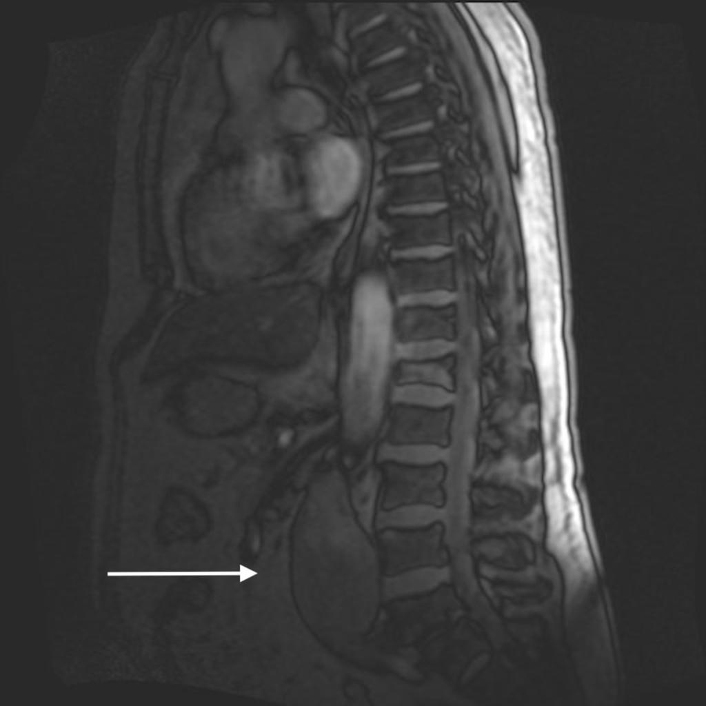 Fig. 4: An incidental abdominal aorta aneurysm of 5.