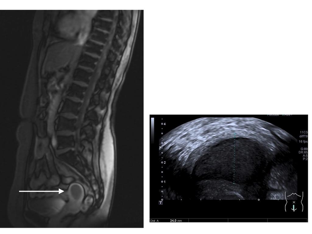 Fig. 11: On the scout view of the MRI lumbar spine there was a markedly distended endometrial cavity.