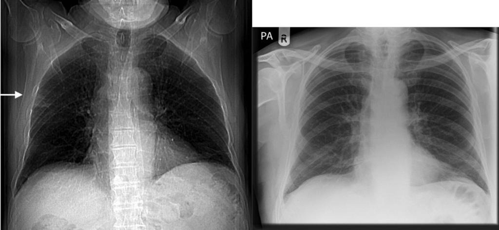 Fig. 14: A peripheral consolidaton in the right upper lobe, probably pneumonia, which could be seen in the scout view, therefore chest x-ray could