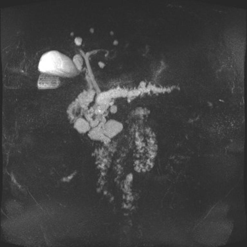 Fig. 19: Further MRI pancreas and MRCP confirmed a multi-cystic lesion in the pancreas