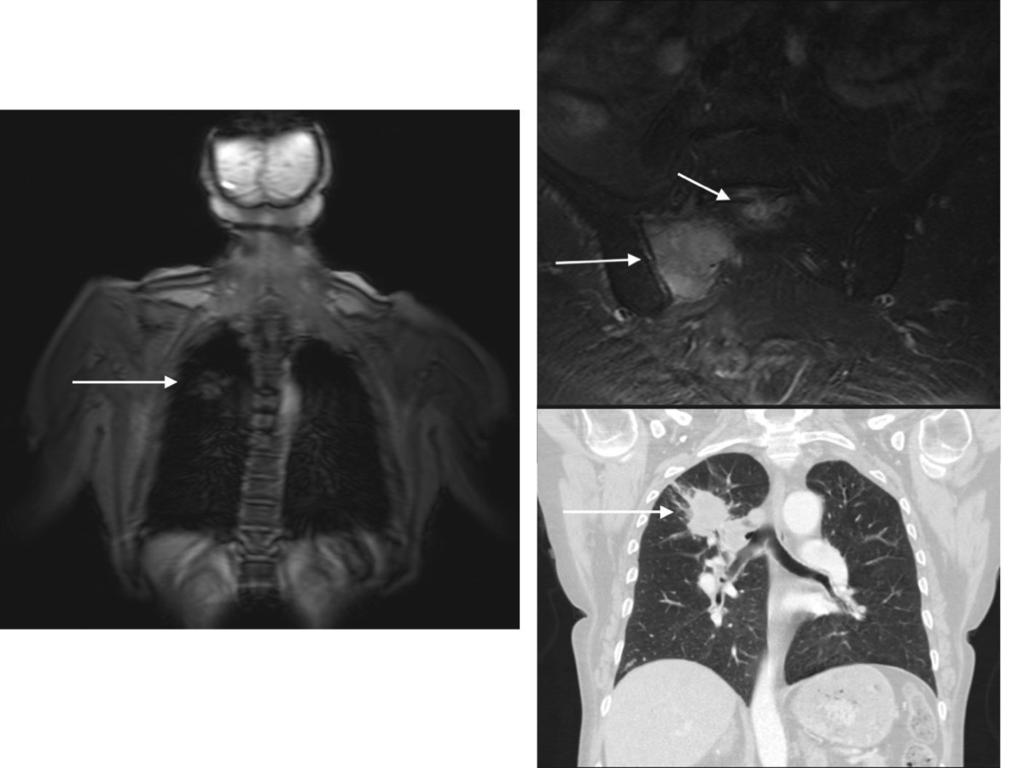 Fig. 12: On the MRI exam of the thoracic and lumbar spine there is right sacral mass with bone destruction (right upper image. arrow).