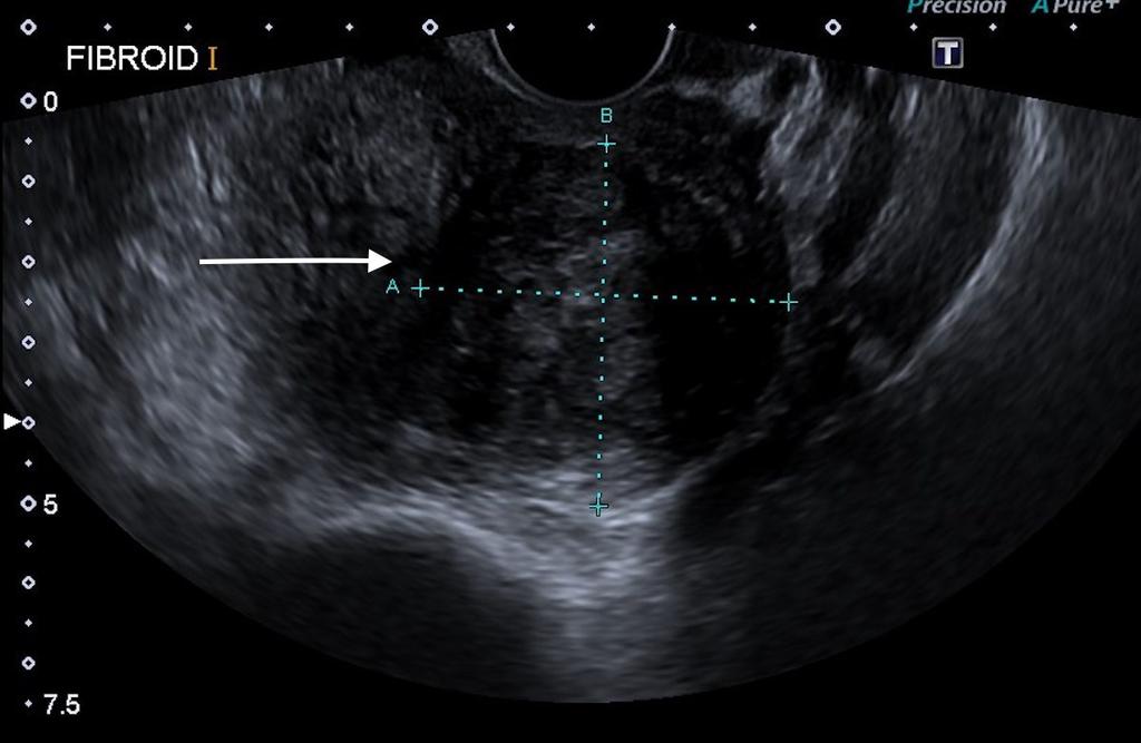 Fig. 17: Further analysis with ultrasound confirmed the diagnosis of a