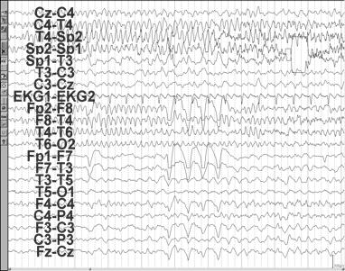Continuation of same seizure Right temporal seizure with maximal phase reversal in the right sphenoidal electrode Absence Myoclonic Atonic Tonic Tonic-Clonic 19 20!