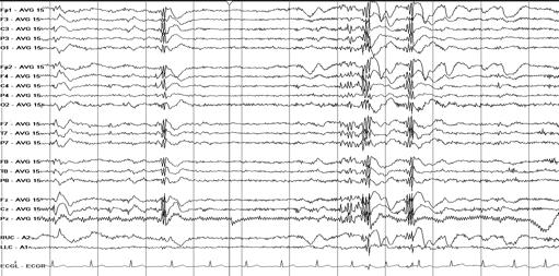 Brief, shock-like jerk of a muscle or group of muscles! Epileptic myoclonus!! Typically bilaterally synchronous!! Impairment of consciousness difficult to assess (seizures <1 second)!