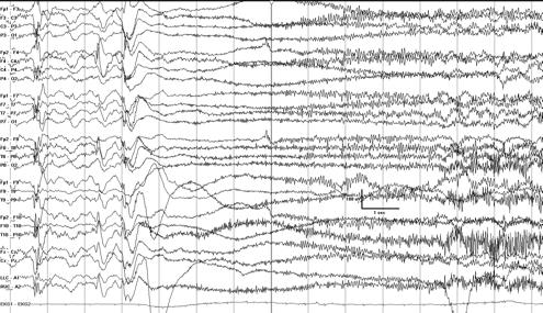 EEG: 4-6 Hz polyspike-wave discharges Myoclonic 27 28 Tonic seizures!! Symmetric, tonic muscle contraction of extremities with tonic flexion of waist and neck!! Duration - 2-20 seconds.