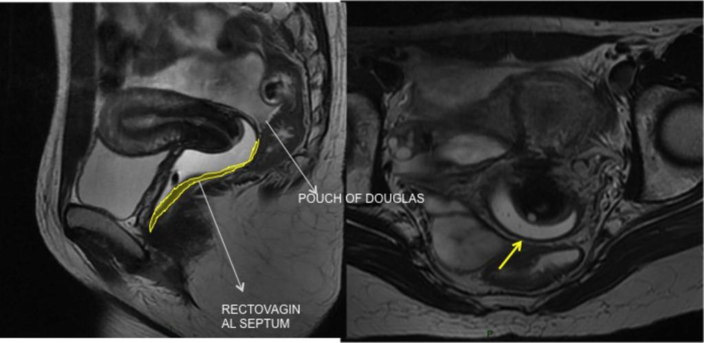 vesicouterine recess. The yellow arrow shows previous caesarean scar and the green curved arrow an endometrioma. Fig. 3: Figure 3: Anatomy of the posterior compartment.