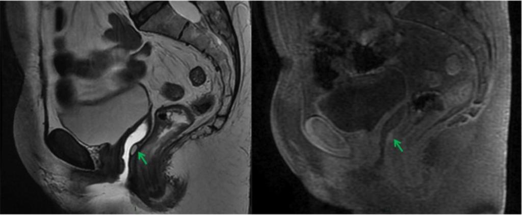 Sagittal T2-weighted MR image shows endometric tissue infiltrating the posterior uterine serosal, obliterating the pouch of Douglas, with retraction and fibrosis in