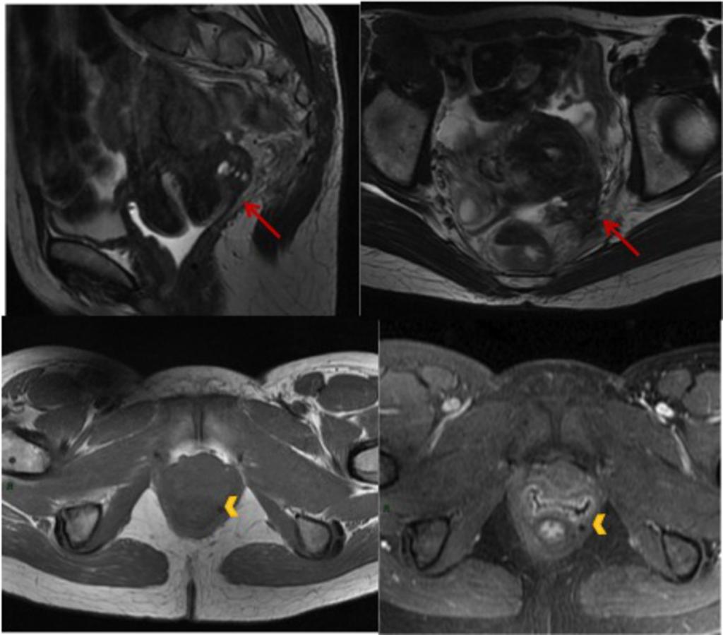 Fig. 8: Figure 8: Infiltrating endometriotic implant on left posterior vaginal fornix causing left ovarian retraction, extending posterolaterally to he left uterosacral ligament, invading the left