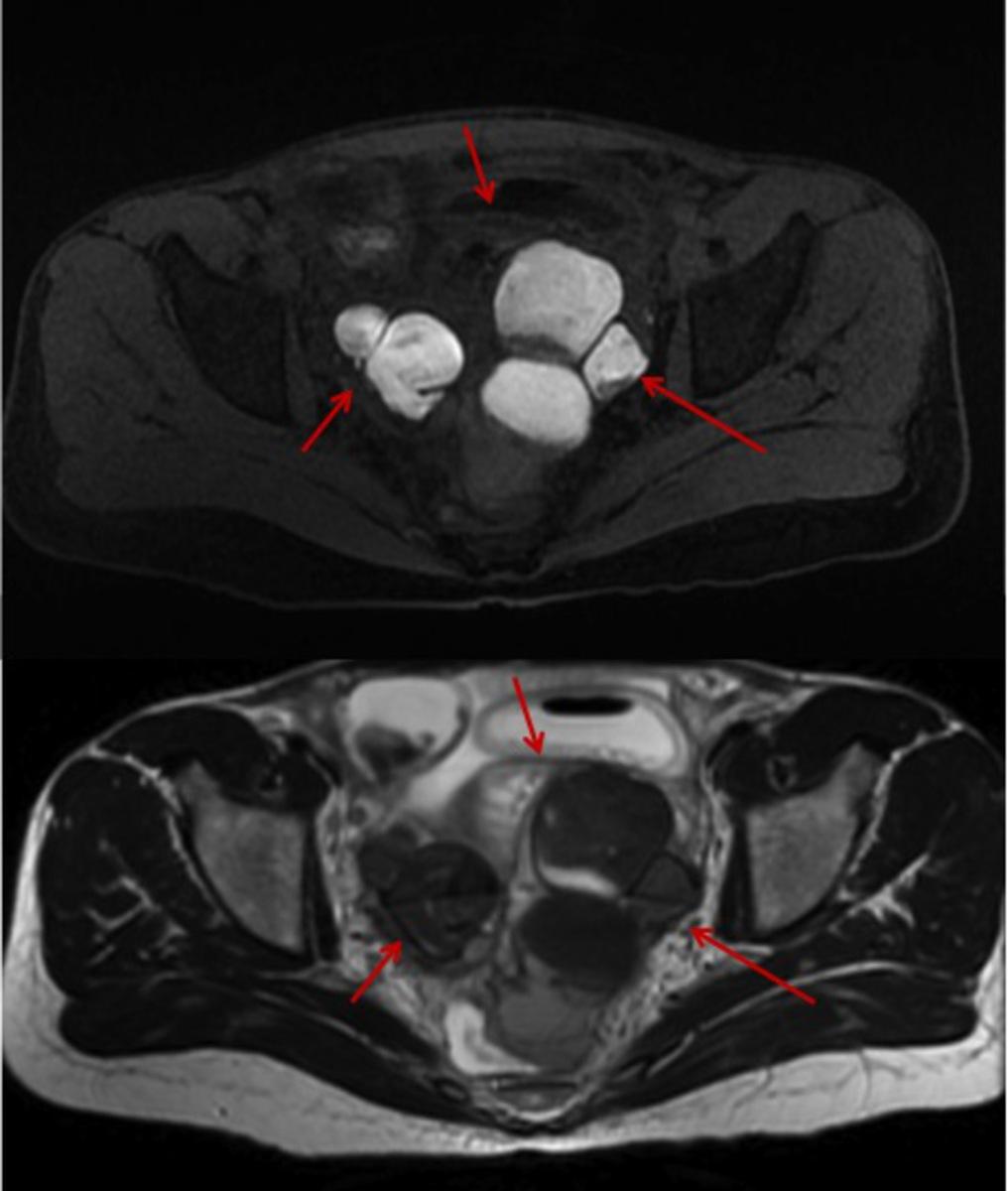 Fig. 10: Figure 10: Classic sonographic appearance of an ovarian endometrioma as a well-defined lesion with homogenous and moderately echogenic content. Fig. 11: Figure 11: Ovarian endometriotic cysts (endometriomas).