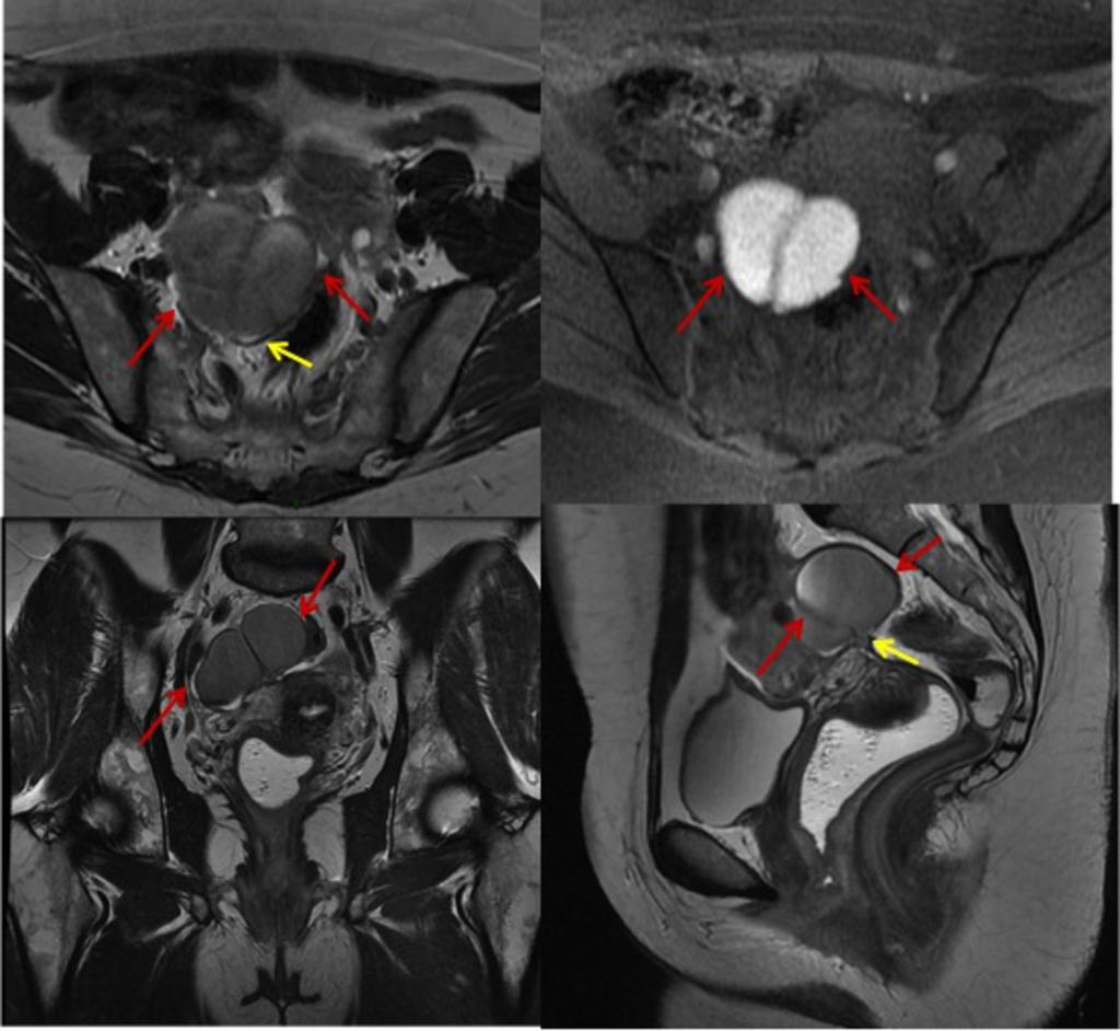 Fig. 12: Figure 12: Right haematosalpinx (red arrows) and adhesions (yellow arrows) in the context of endometriotic