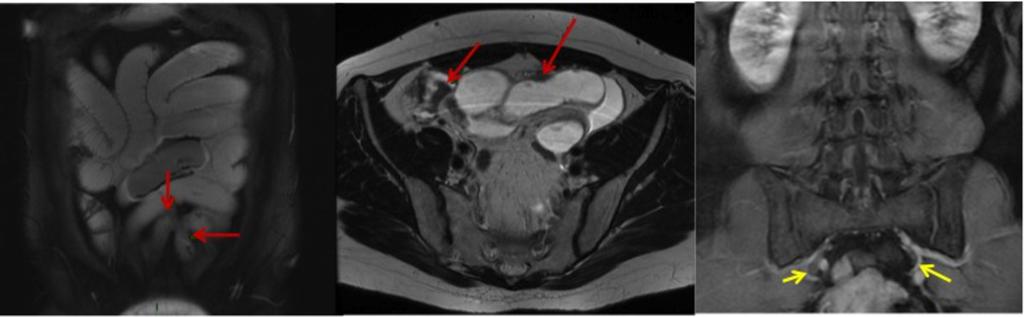 Fig. 16: Figure 16: MRI enterography.
