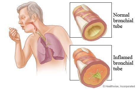 The inflammation leads to edema of the bronchiole s mucus cells increase secretion of mucus presence of cough + crackle sound.