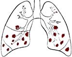 Bacterial & Viral invaders act differently within the lung 2- bronchopneumonia: Viruses inter respiratory tract through