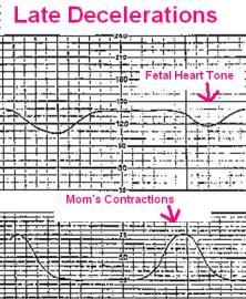 Generalized Seizure during Delivery Seizures increase risk of morbidity and mortality, thus need for AEDs during pregnancy for some WWE Fetal heart rate tracing during a maternal generalized tonic