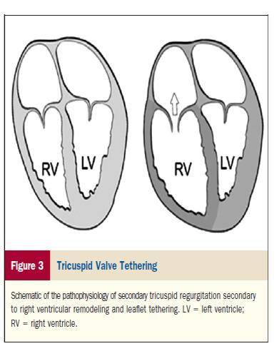 TR PATHOPHYSIOLOGY Tricuspid regurgitation RA pressure CVP RV volume overload Renal dyfunction Symptoms and signs of RV failure RV dysfunction Cardiac output TV dysfunction following CIED