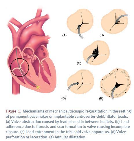 MECHANISMS OF LEAD-RELATED TV DYSFUNCTION Structural consequences include: Valve leaflets, papillary muscles or chordae tendineae damage during lead placement or manipulation (perforation.