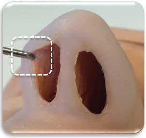 nostril. A small conventional scalpel incision at the target cannula entry location may be optionally created to ease cannula puncture.