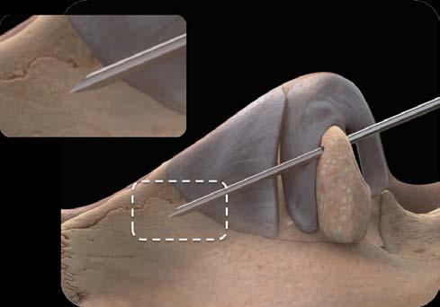 1. Instructions For Use Figure 9: Cannula at target depth mid-thickness within the lateral wall structure. The intended position of the cannula tip and cannula are shown in the magnified views 12.