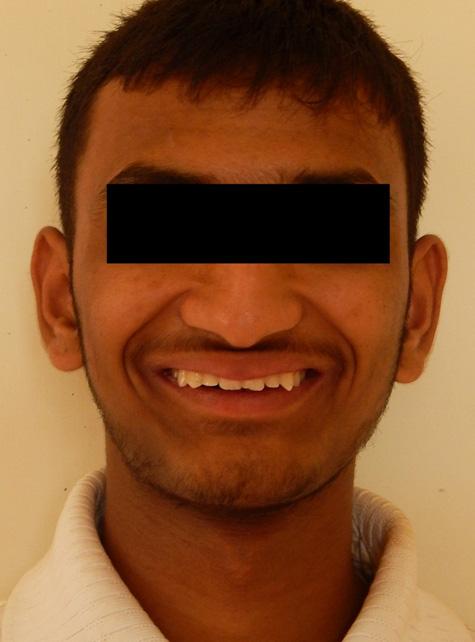 Intra-oral frontal view of case 3.