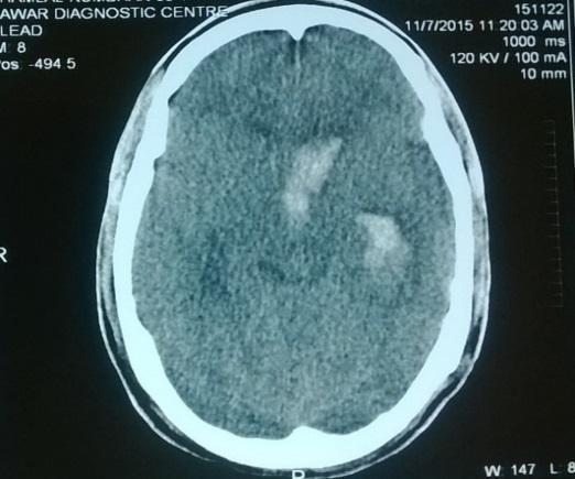 Romanian Neurosurgery (2017) XXXI 3: 364-367 365 Case report A 36-year-old male patient presented to our outpatient department with complaint of sudden onset severe headache, dizziness and nausea for