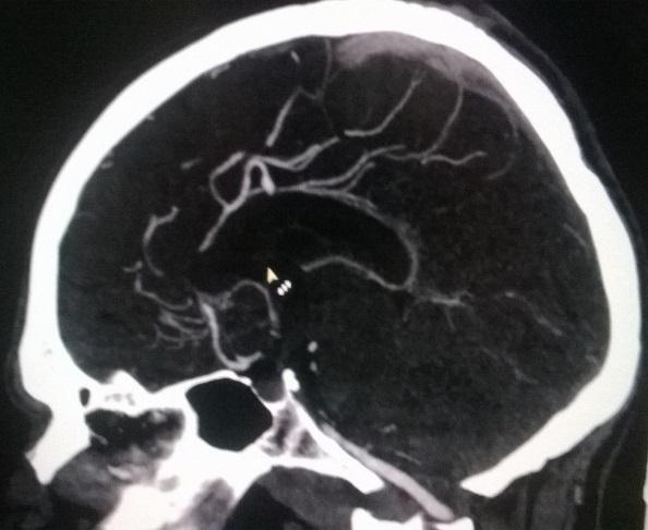 Non-contrast CT shows intraventricular hemorrhage involving lateral, third and fourth ventricle. [Figures 1A and 1B] CT angiography revealed right side DACA aneurysm.