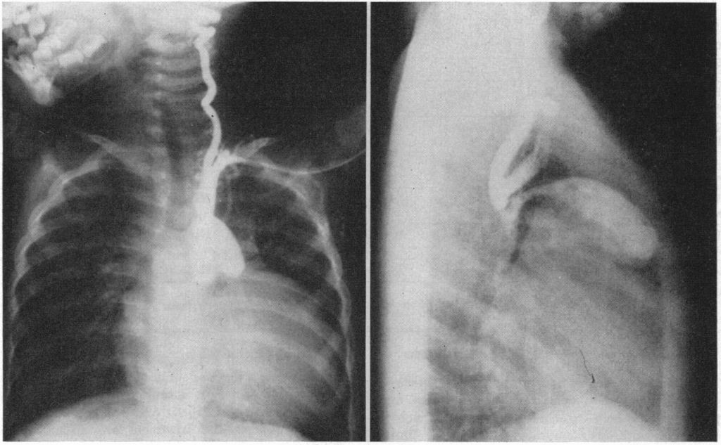 valves. three episodes of cardiac failure treated by hospitalization and digitalization. There was a history of frequent upper respiratory tract infection.