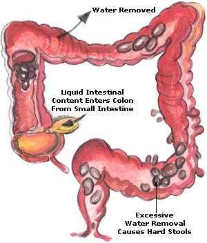 Constipation (Large Intestine) Resulting Imbalance: Discomfort during bowel