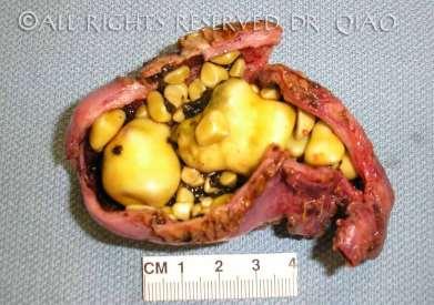 Gallstones (Gall Bladder) Resulting Imbalance: Blocked duct (tube)