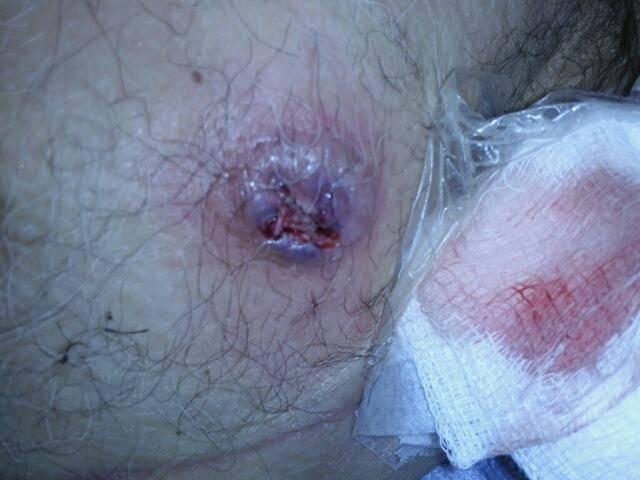 Skin Lesions Erythematous nodules which