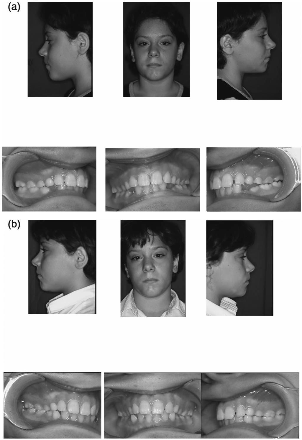 PALATAL CANINES IN MZ TWINS 467 FIGURE 1.