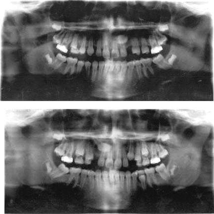 PALATAL CANINES IN MZ TWINS 469 FIGURE 3. Panoramic radiographs, progress, at age 12.0 years. (a) MZ twin ES, (b) MZ twin DS. TABLE 1.