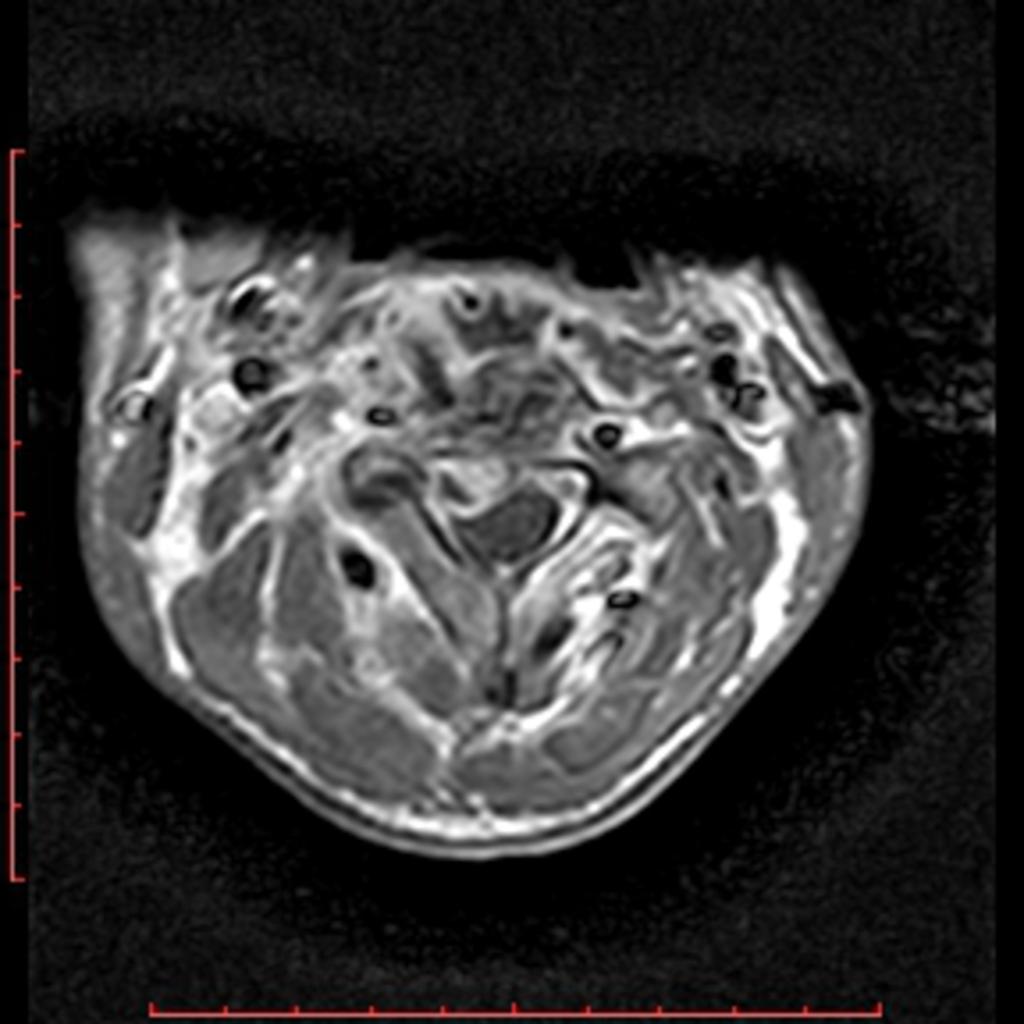 Fig. 4: MRI, T1wI post gadolinium administration, axial plane, of the same patient, showing the