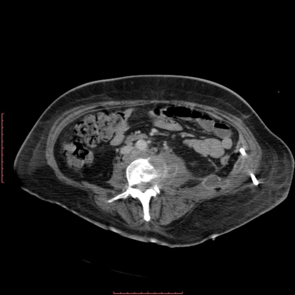 Fig. 5: CT, axial image, post intravenous contrast administration, in a 52 year old woman with Pott disease, showing an L1 osteolytic