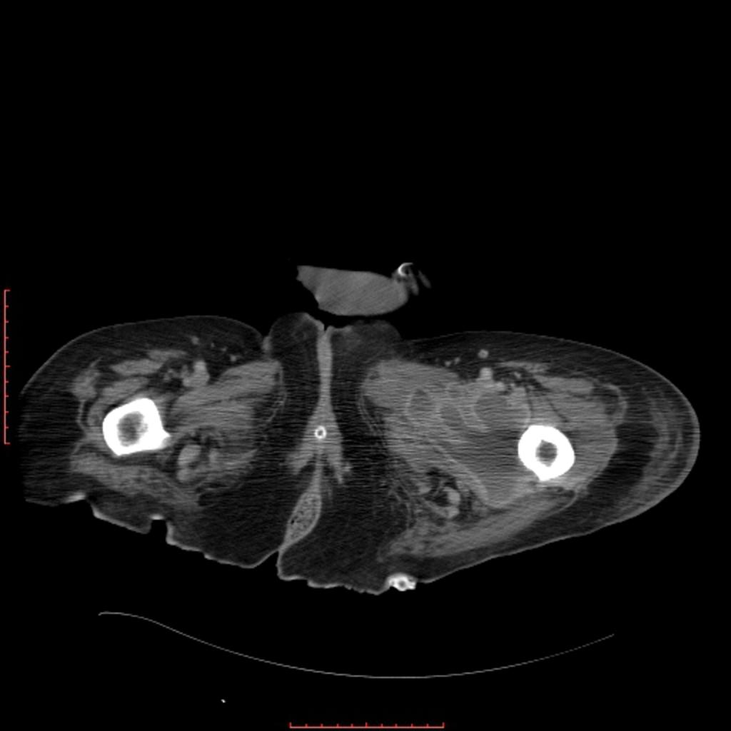 Fig. 6: CT, axial image, post intravenous contrast administration, of the same patient, showing