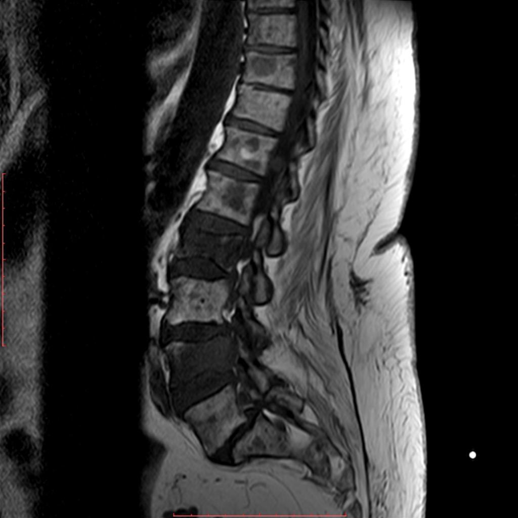 Fig. 9: MRI, T1wI, lumbar spine, sagittal plane, of a 65 year-old woman with vertebral metastases, showing pathologically low signal in several