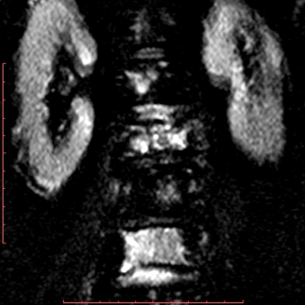 Fig. 10: MRI, DWI, coronal plane, in a man with vertebral metastases, showing restricted diffusion