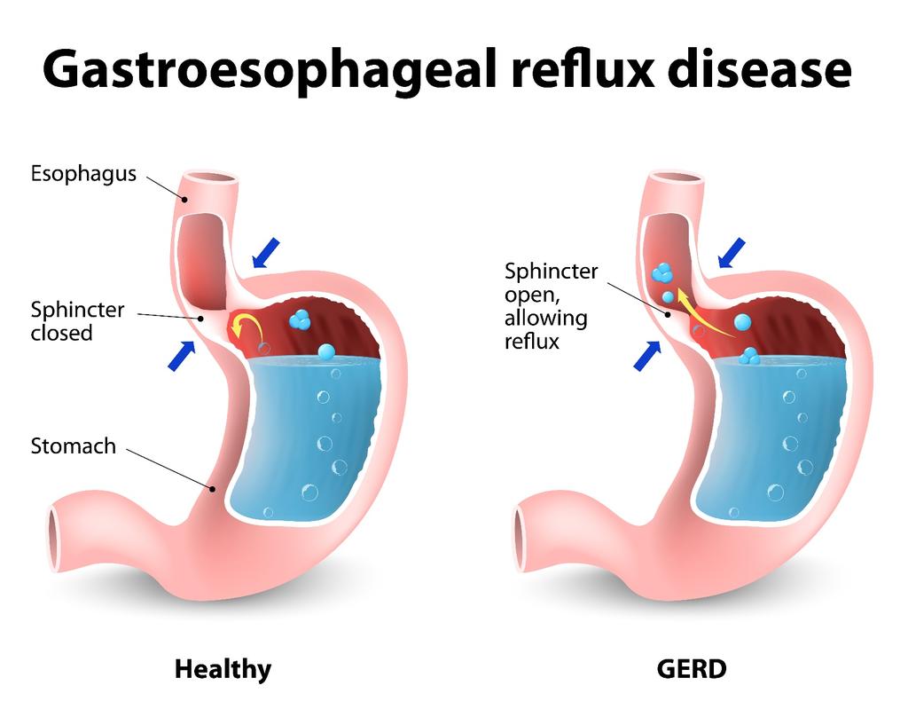 The Montreal Definition and Classification of Gastroesophageal