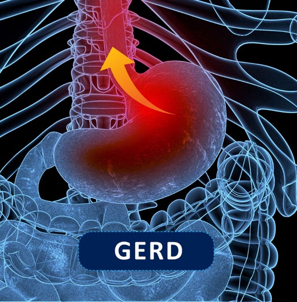 GERD Symptoms Heartburn (acid indigestion) Painful burning sensations in the throat or chest Wheezing, symptoms of asthma, chronic