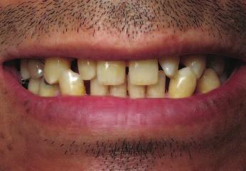 From an aesthetic perspective, even though the wax does not reproduce the tooth shade perfectly, it facilitates visualisation of the shape and position of the teeth in the concept.