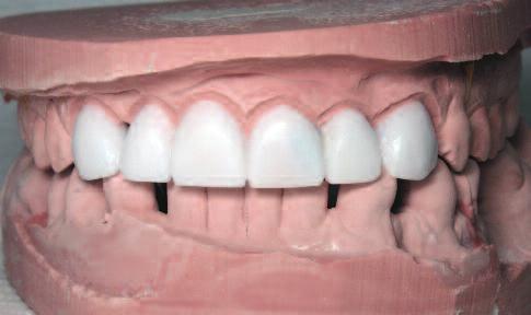 Figure 5: Wax-up without preparation of the teeth. Figure 6: Silicone wax-up impression. Figure 7: Verification of the accuracy of the wax-up impression.
