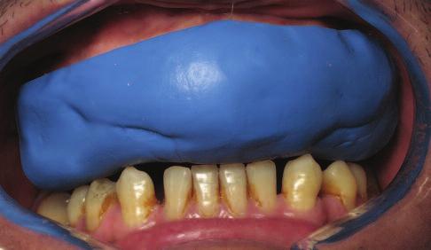 Figure 9: Insertion of the impression with self-curing composite. Figure 10: Occlusal view of the mock-up following removal of the impression and all excess material.