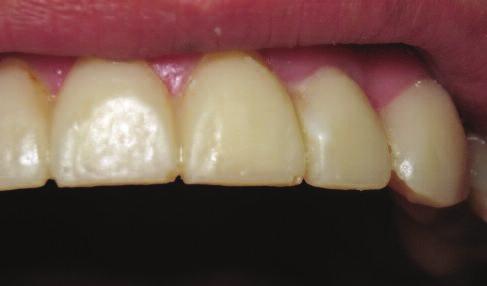 Figure 13: Surface of the mock-up at tooth UL1 following filling of the defect. Figure 14: Postoperative situation, occlusion check.