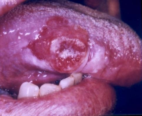 Oral Cancer Iatrogenic xerostomia 65 year old male on multiple medications for depression and heart disease develops severe