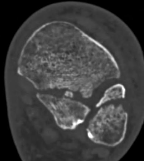 musculoskeletal imaging Figure 2. () Routine bone; () HD bone Figure 3.