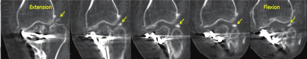 Figure 9. The coronal phased images reveal the movement of large fracture fragment in to the joint space. Figure 10.