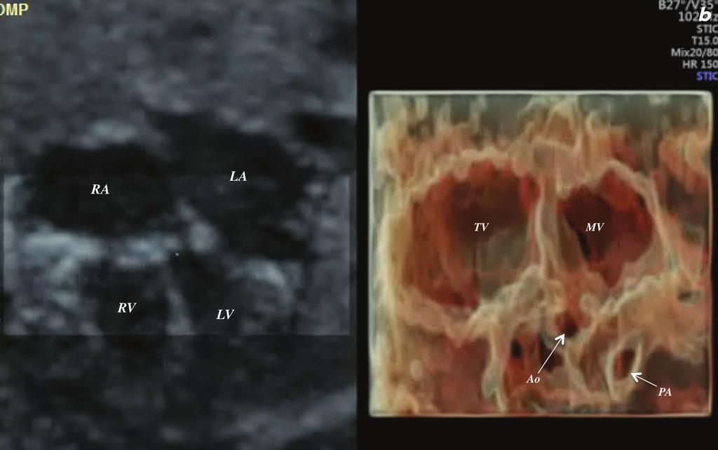 Consecutive HDlive silhouette mode image of an en face view of 4 cardiac valves in a normal fetal heart at 20