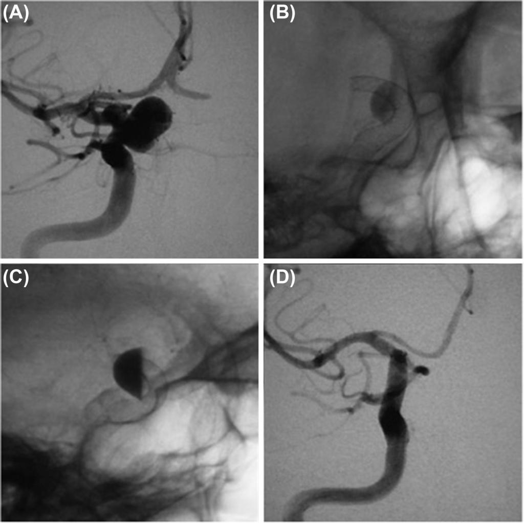Repor t of Flow Diver ter Clinical Trials in Japan Fig. 4 48-year-old female with asymptomatic left ICA aneurysm. (A) Pretreatment working projection. (B) Pipeline 5 mm/10 mm was deployed.